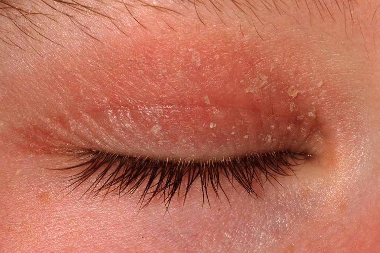 Two ingredients in your brow and lash serum that reactive skin cannot tolerate
