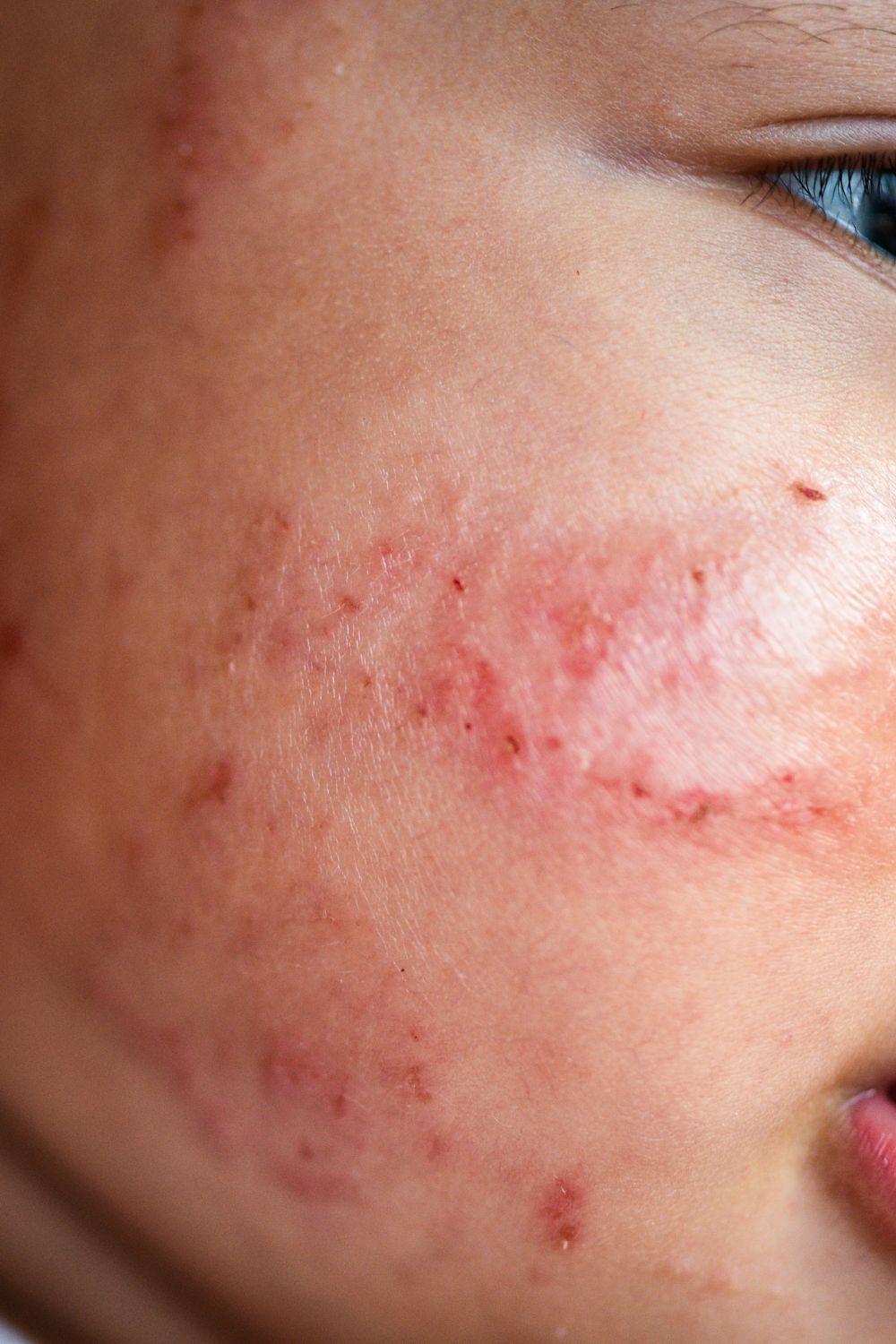 The problem with over-exfoliating your skin